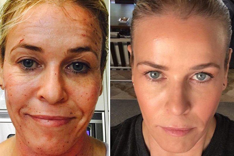 Chelsea Handler Skin Secret Profractional Laser