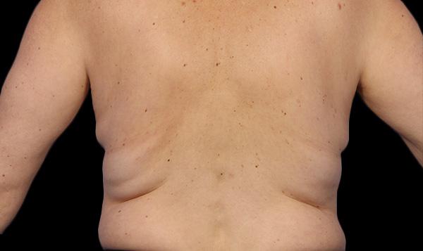 4-before-coolsculpting-lose-fat-everyoung-med-spa-coquitlam-burnaby-port-coquitlam-BC-back-fat