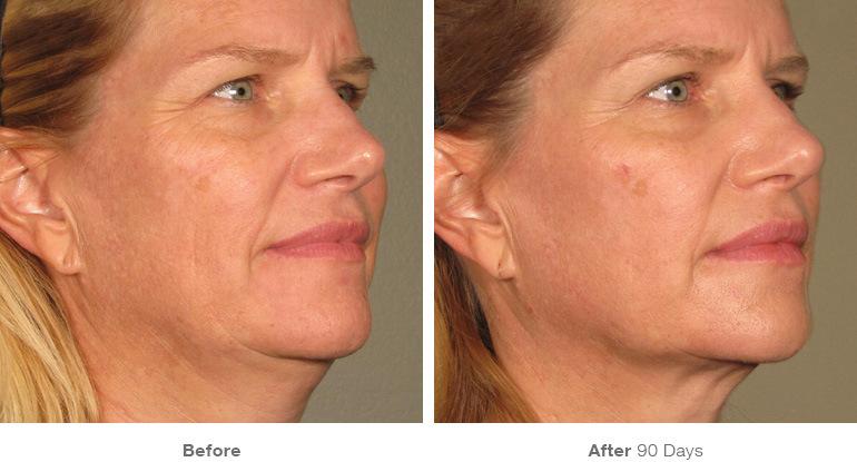 before_after_ultherapy_results_full-face21