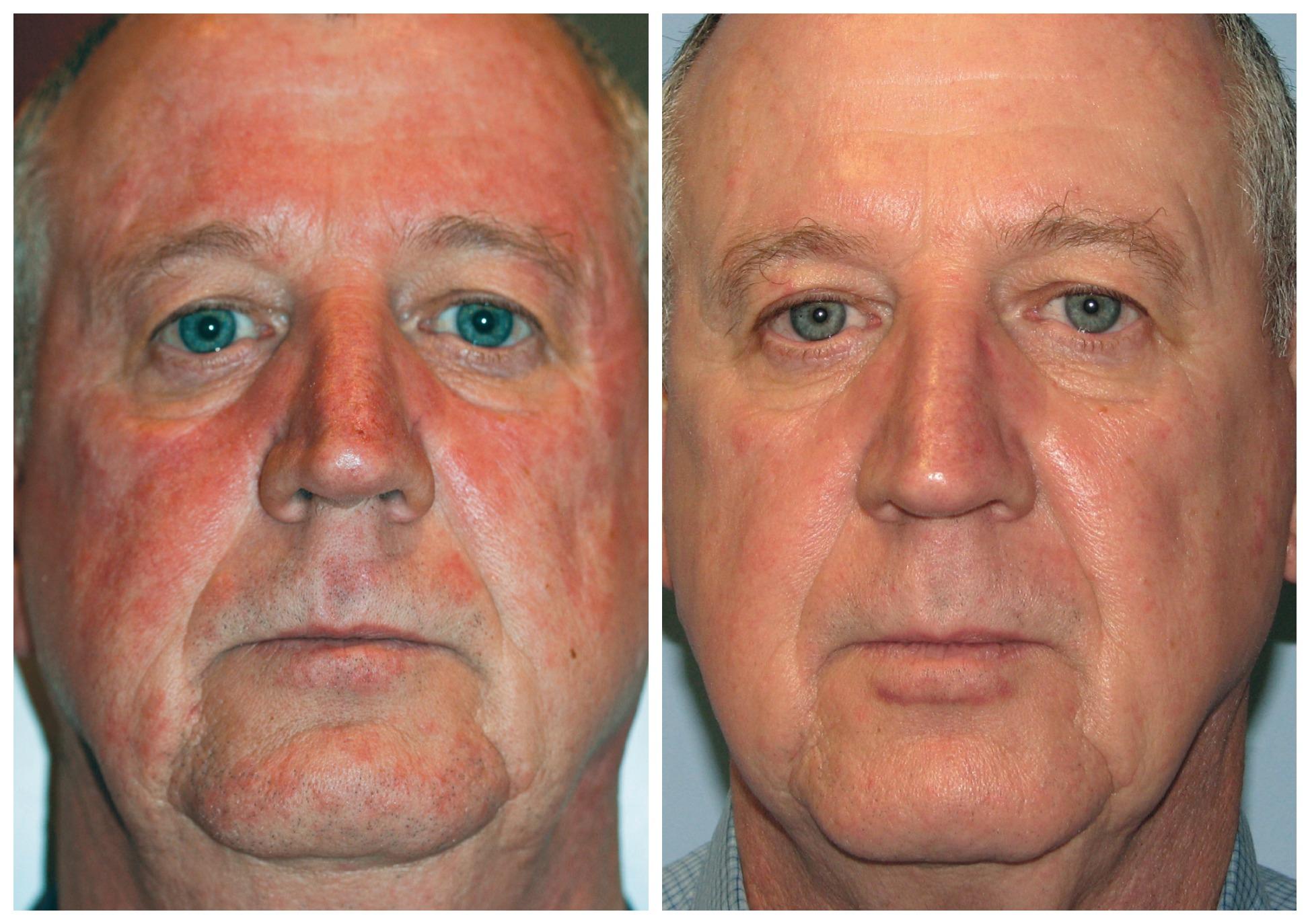 EverYoung-rosacea-redness-vein-brown-spot-treatment-vancouver-port-coquitlam-Burnaby-BC
