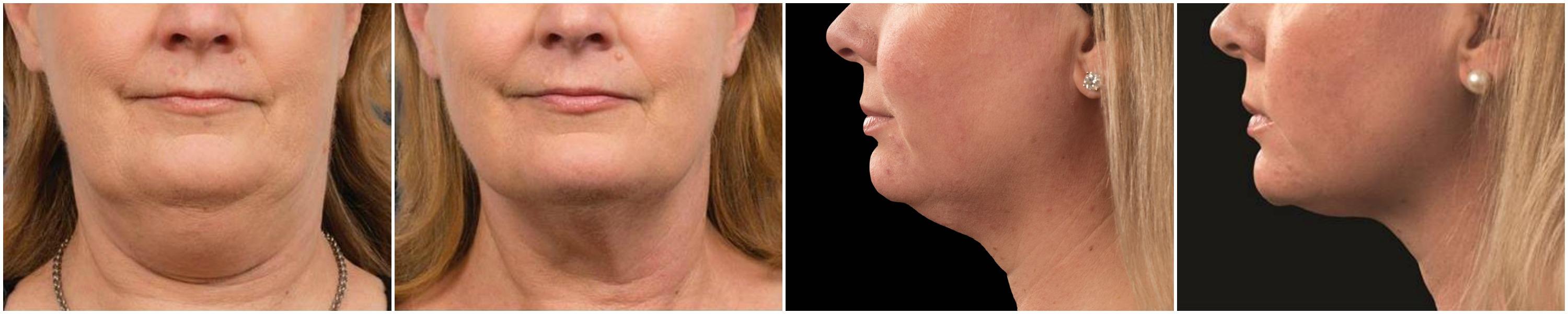 EverYoung CoolsCulpting cool min double chin fat reduction port coquitlam vancouver bc