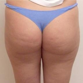 3-velashape-before-and-after-butt-velashape-before-after-EverYoung-Medical-Aesthetics-cellulite-fat-loss-Vancouver-Port-Coquitlam