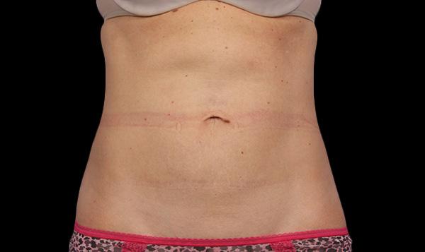 2-coolsculpting-everyoung-best-medspa-coquitlam-fat-freezing-burnaby-Port-Coquitlam-lose-fat-body-contouring