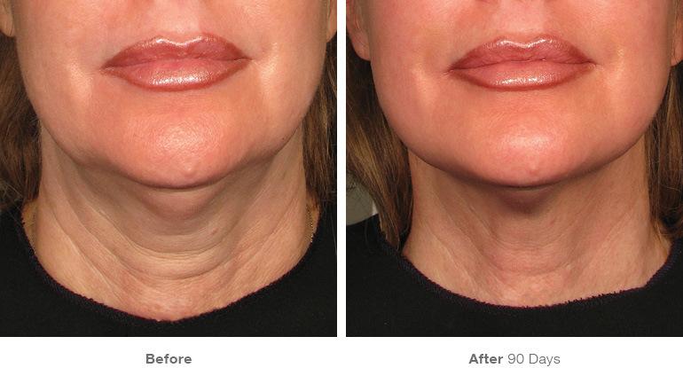 ultherapy before and after mouth