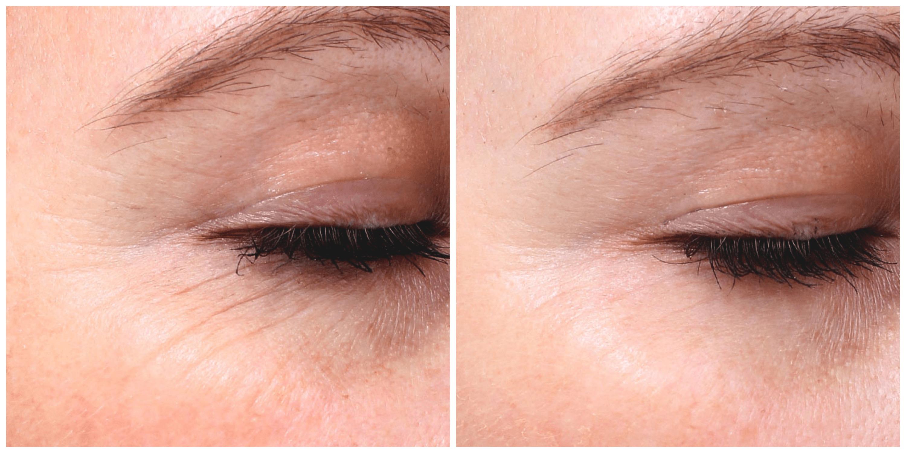 everyoung vancouver picosure laser wrinkle removal