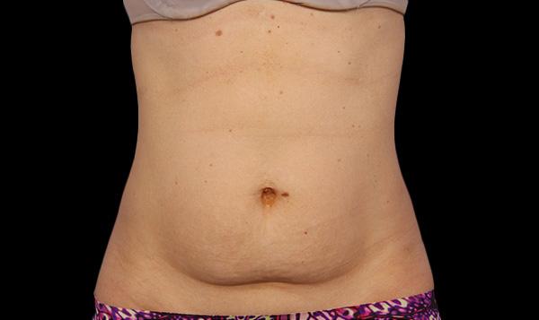 2-after-coolsculpting-port-coquitlam-fat-loss-body-contouring-coquitlam-burnaby-medspa