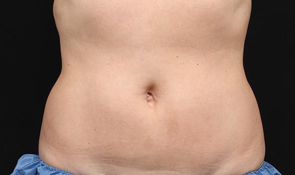 3b-after-coolsculpting-port-coquitlam-cosmetic-doctor-lose-fat-tummy-coquitlam-burnaby-medspa