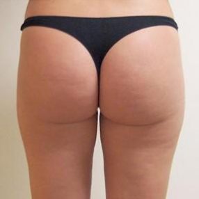 4-velashape-before-and-after-butt-velashape-before-after-EverYoung-Medical-Aesthetics-cellulite-fat-loss-Vancouver-Port-Coquitlam