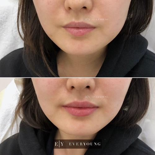 1e-Everyoung-lip-augmentation-lip-injections-dermal-fillers