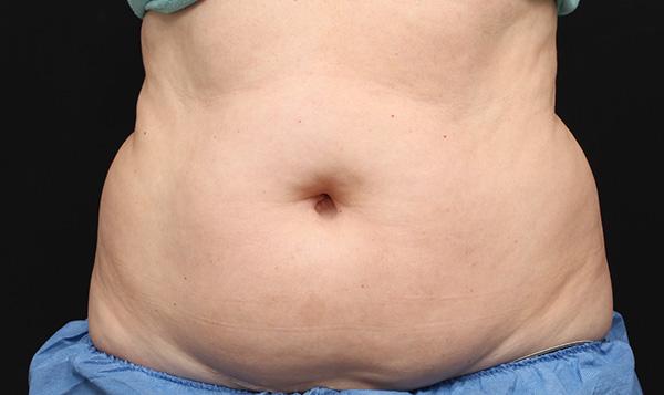 3-before-coolsculpting-lose-fat-lose-weight-body-contouring-port-coquitlam-coquitlam-burnaby-medspa