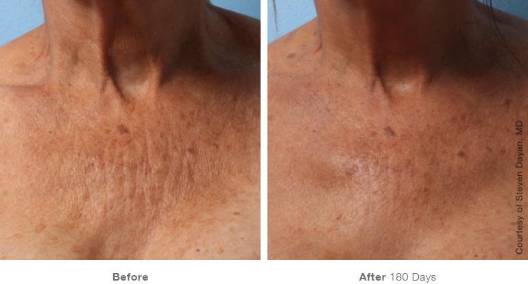 ultherapy vancouver before and after chest skin