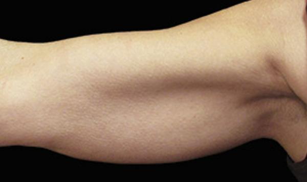 6a-coolsculpting-arm-fat-everyoung-medspa-cosmetic-clinic-port-coquitlam-burnaby-coquitlam-bd