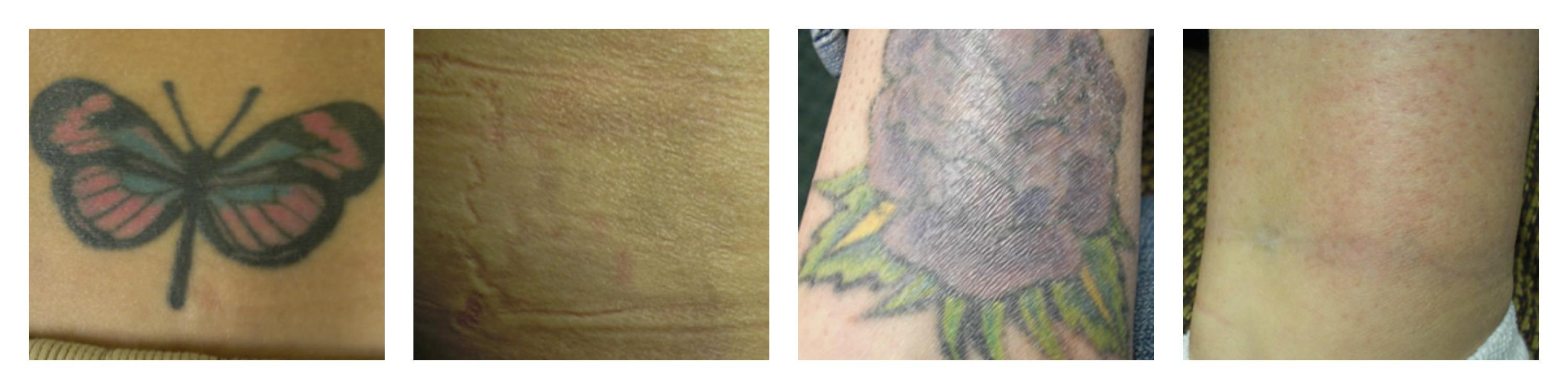 everyoung tattoo removal in port coquitlam burnaby vancouver bc q switched laser VRM