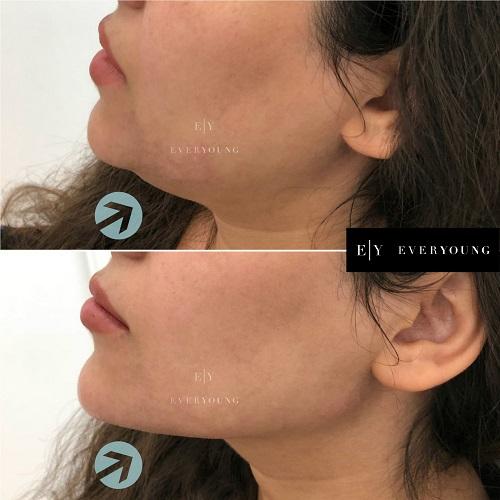 1 dermal fillers and Cheek and chin enhancement Everyoung jawline contouring dermal fillers