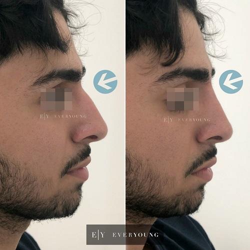 Everyoung rhinoplasty non surgical