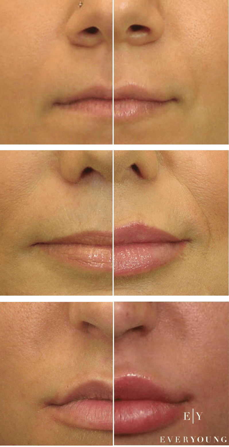 EverYoung lip augmentation mini lip to full lips lip injections coquitlam vancouver BC